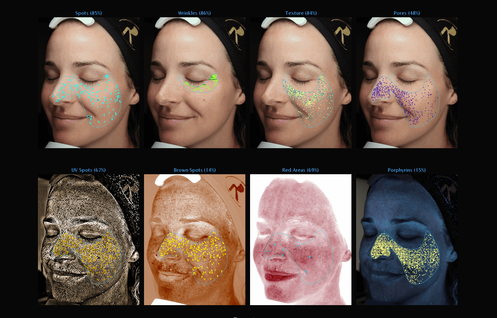 VISIA scan example