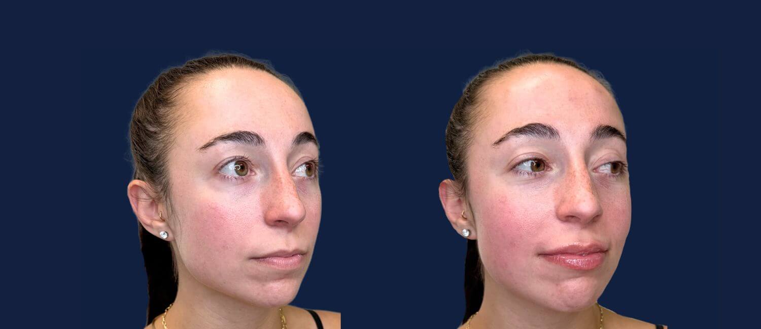 lip filler before and after