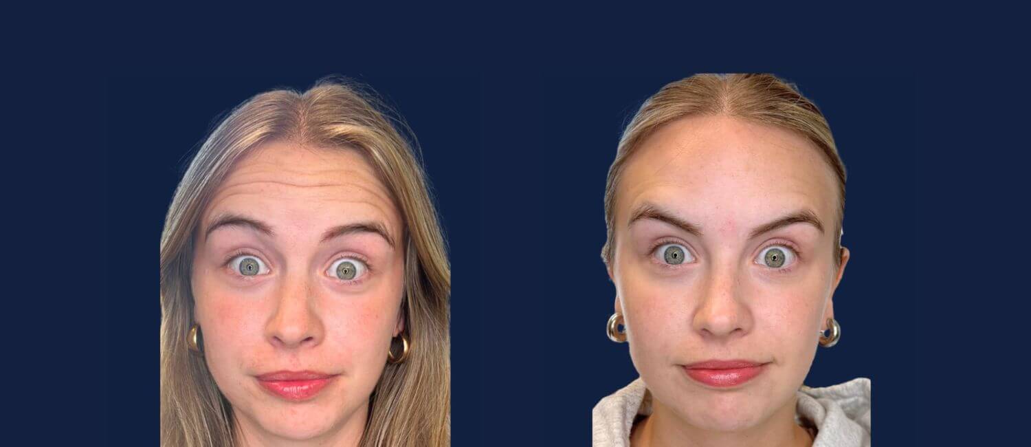 botox before and after photos